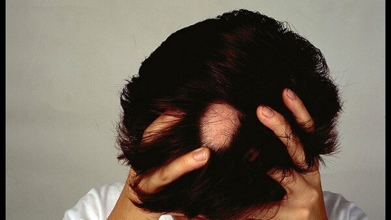 En el piso Desobediencia Barriga Alopecia: remedios naturales para combatirla | Trucosnaturales.com